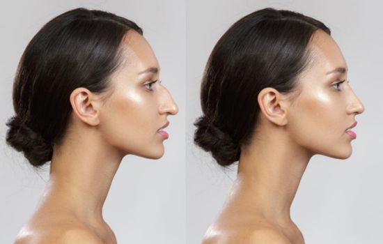 Experimente a Rinoplastia Virtual com o App "Editor de Nariz"