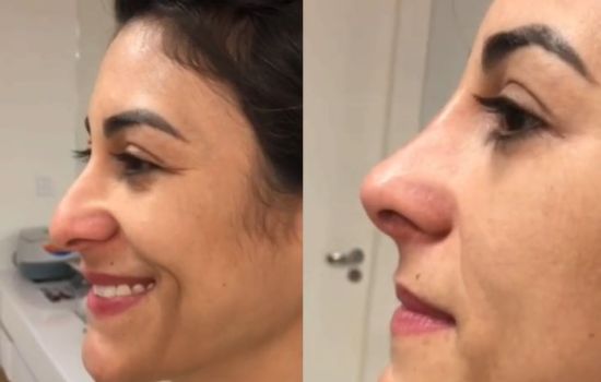 Transformação Virtual: Aplicativo de Simulação de Rinoplastia